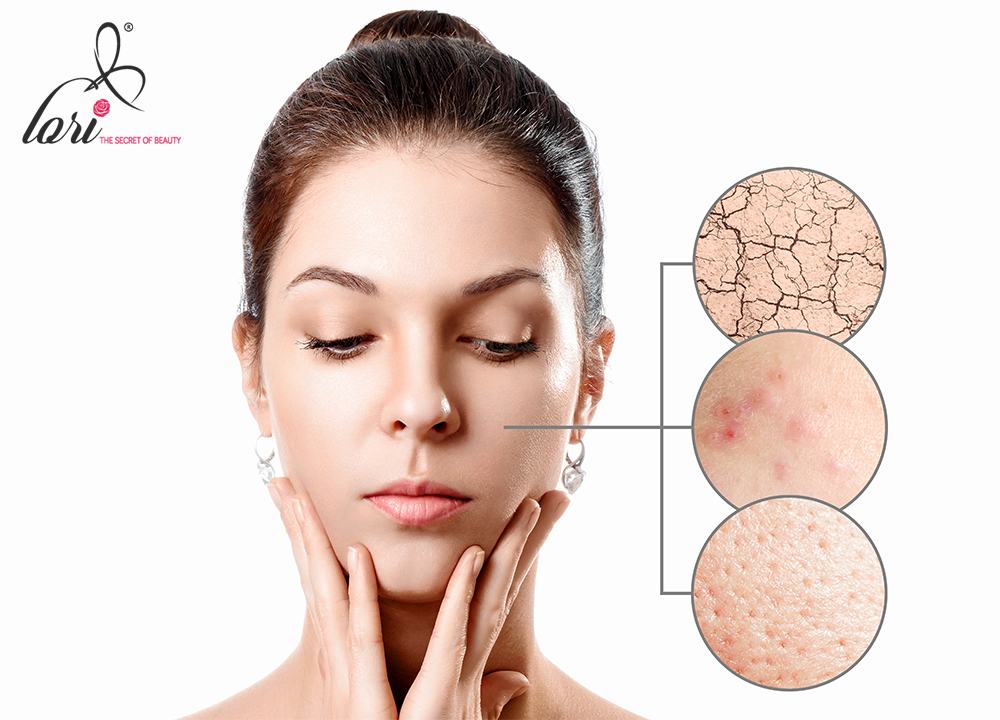 Da hỗn hợp được chia làm 2 loại đó là: da hỗn hợp thiên khô và da hỗn hợp thiên dầu.