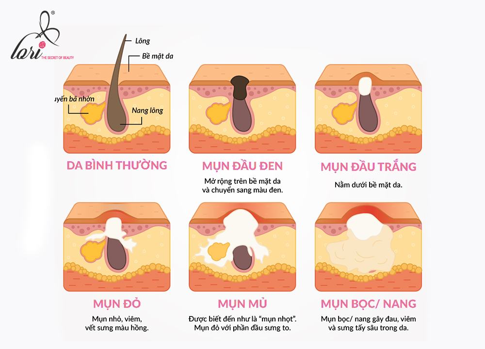 Mụn bọc là loại mụn có nguy cơ để lại vết thâm và sẹo cao nhất trong các loại mụn.