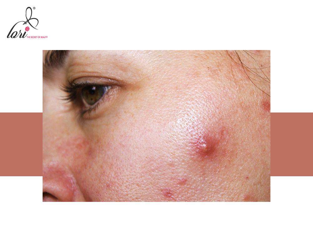 Ngoài ra, mụn bọc ở má còn do việc tiêu thụ đường cao, ăn quá nhiều đồ ngọt.