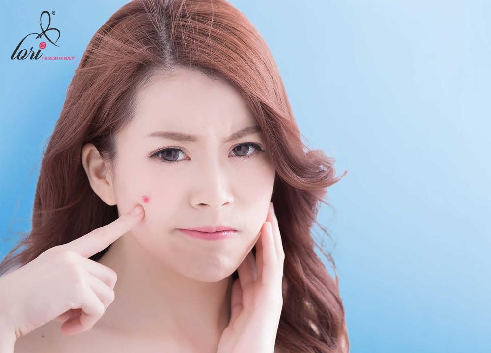 Nam, nữ độ tuổi dậy thì là đối tượng có tâm sinh lý thay đổi nhiều, dễ bị rối loạn hormone gây tình trạng mụn bọc.