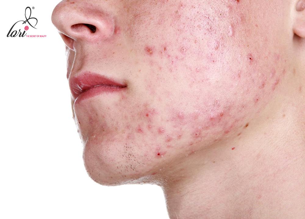 Các hormone này kích thích tuyến bã nhờn tiết ra một lượng lớn dầu nhờn và gây bít kín lỗ chân lông.