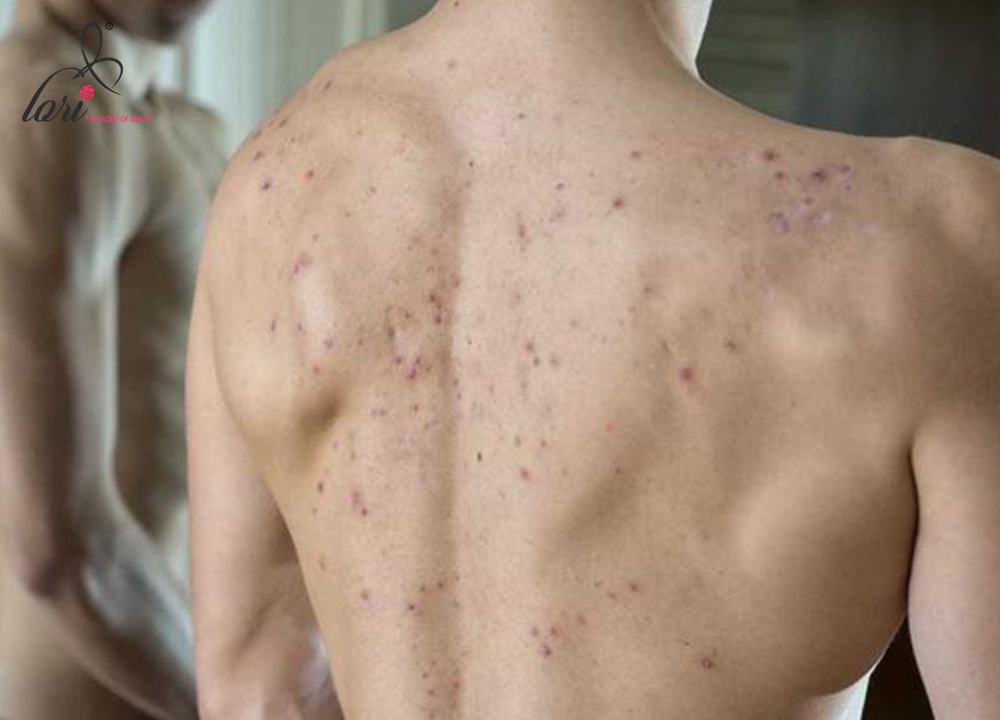 Nếu mụn ở lưng, vai hoặc ngực, hãy mặc quần áo rộng rãi thoáng mát và chất liệu thấm hút mồ hôi.