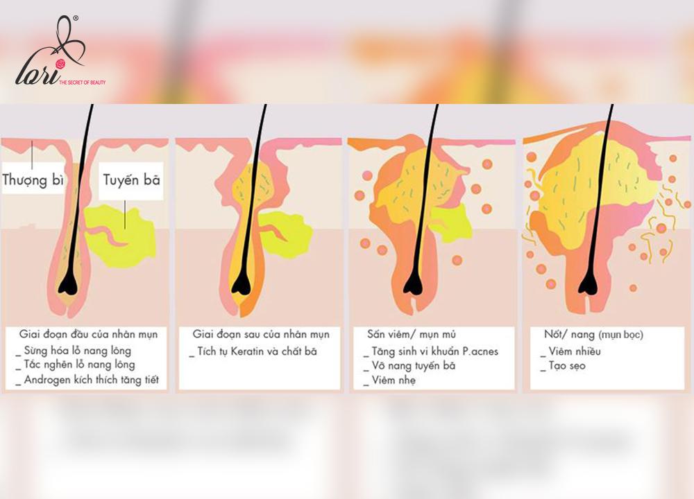 Mụn trứng cá là một bệnh lý về da rất phổ biến và thường gặp nhất ở độ tuổi dậy thì do sự thay đổi hormone trong cơ thể.