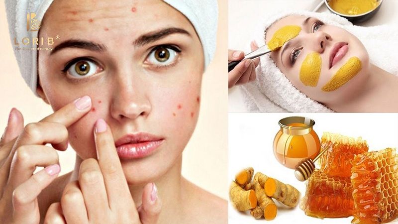 mẹo trị mụn thâm